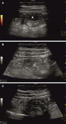 Case report: A rare cause of intestinal perforation in a third-trimester pregnant woman